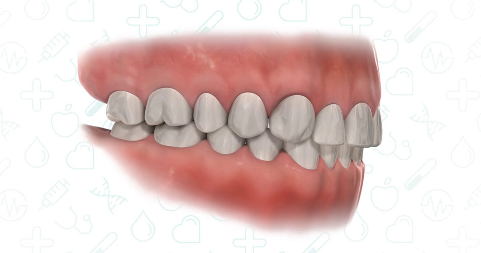 Проблема неправильного прикуса.